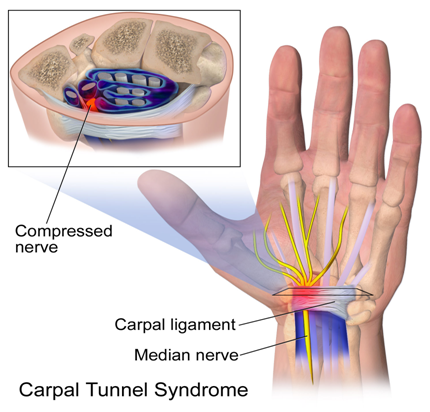 Do you have Carpal tunnel syndrome?