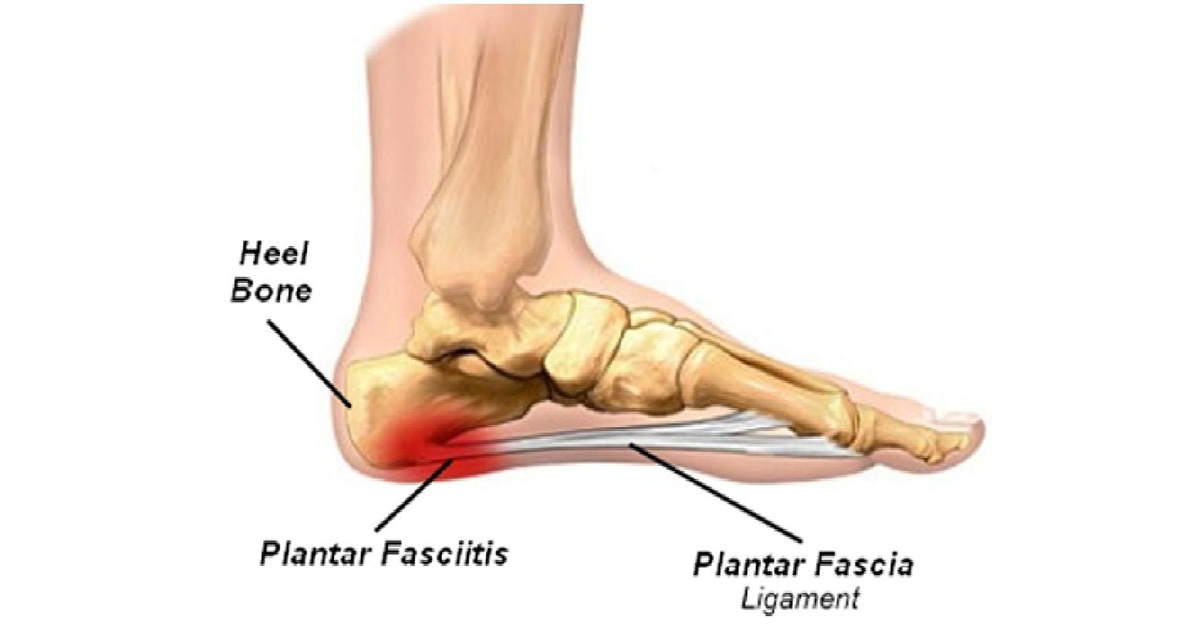 The Rise of Plantar Fasciitis– Everyone's got it…but why?