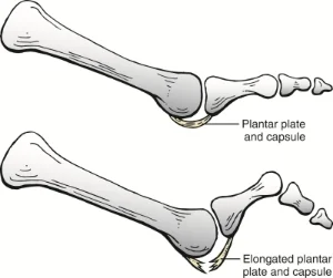 Plantar-plate